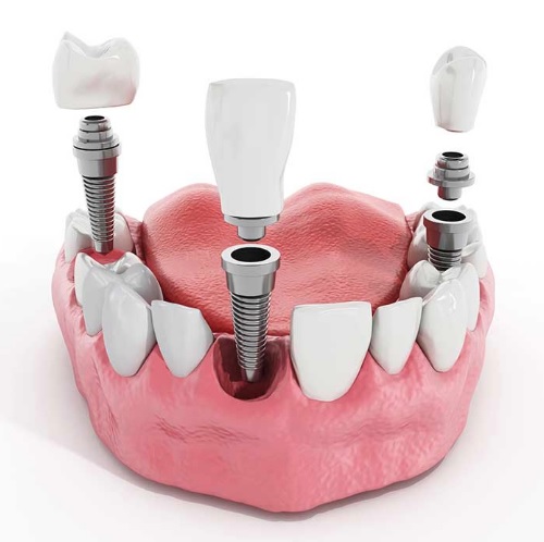 Dental Implant in Sydney