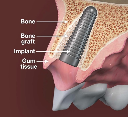 Tooth Implant in Sydney